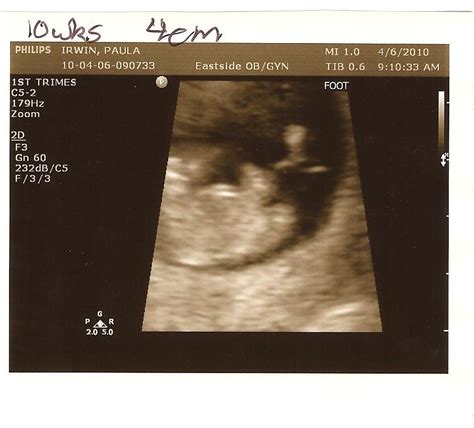 Irwin with an "I": 10 Week Ultrasound