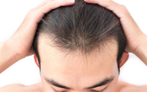 What Are The Main Types Of Hair Loss In Men