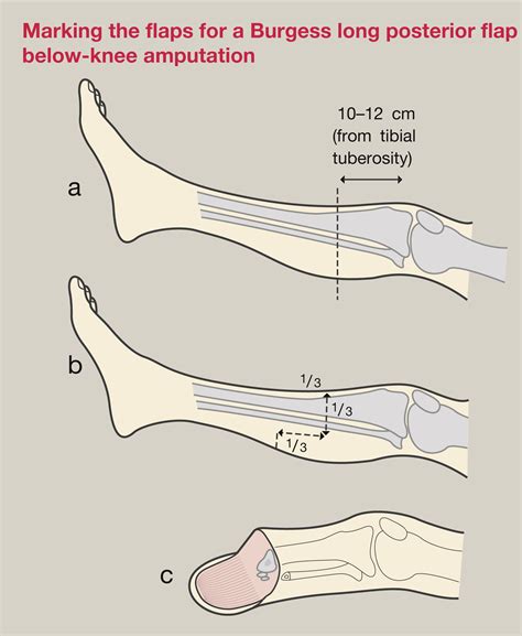 Amputation And Rehabilitation Surgery Oxford International Edition