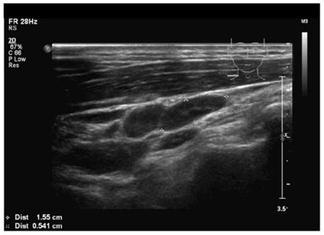 Lymphoma Lymph Nodes Ultrasound