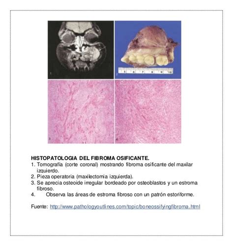 Fibroma Osificante Del Maxilar