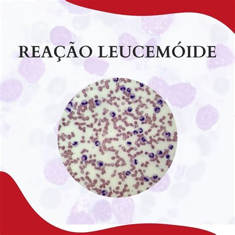 Rea O Leucem Ide Atlas Em Hematologia