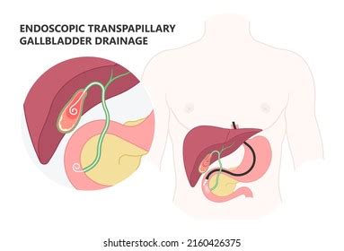 Endoscopic Gallbladder Drainage Medical Surgery Procedure Stock Vector (Royalty Free) 2160426375 ...