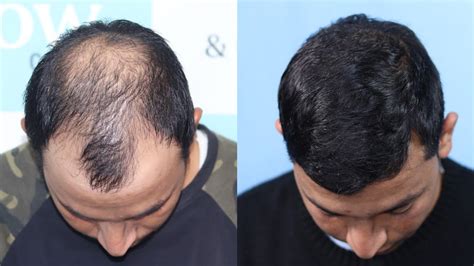 Best Hair Transplant Result 2021 Nw Grade V 4312 Grafts Regrow Clinic Haridwar Youtube