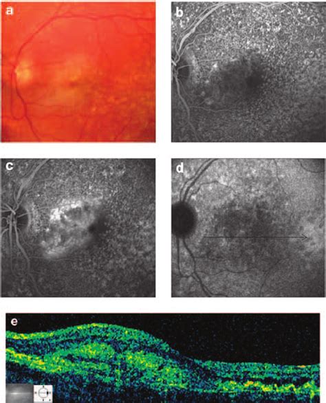 Patient no. 1 affected with basal laminar drusen (BLD) and choroidal ...