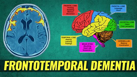 Bruce Willis Has Frontotemporal Dementia Symptoms Causes