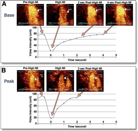 Myocardial Perfusion Imaging With Contrast Ultrasound Jacc