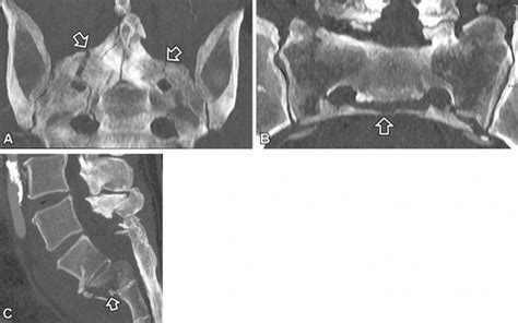 Ct Of Sacral Fractures Classification Systems And Management Radiographics