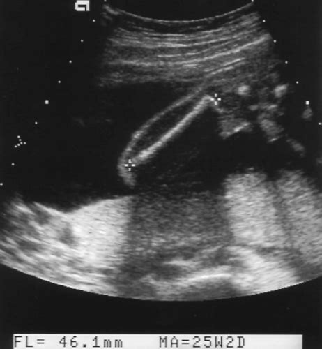 Obstetric Ultrasound–Second and Third Trimester | Radiology Key