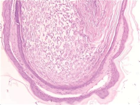 Epidermal Inclusion Cyst Histology