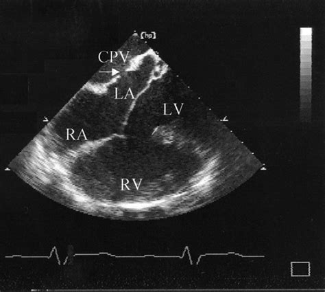 Atrioventricular Septal Defect With Cor Triatriatum Heart