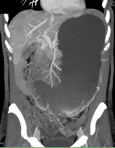 Gastric Outlet Obstruction Caused By Pancreatic Adenocarcinoma