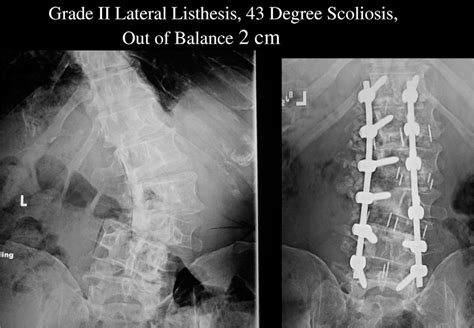 Fig 4 Multilevel Extreme Lateral Interbody Fusion Xlif And Osteotomies For 3 Dimensional