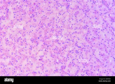 Glóbulos Rojos Infectados Con Plasmodium Parásito Responsable De La Malaria Microscopio óptico