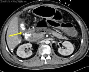 Blunt Abdominal Trauma With Transected Duodenum Radiology Cases