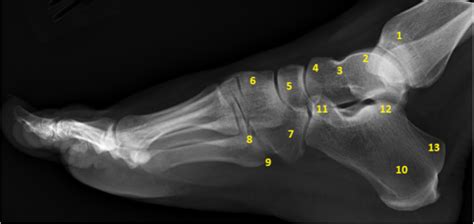 Foot Radiograph Lateral Diagram Quizlet