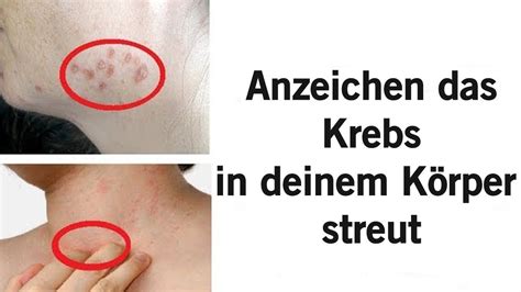 7 Frühe Warnzeichen und Symptome von Krebs meisten Menschen