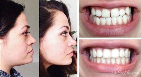 jaw surgery    underbite