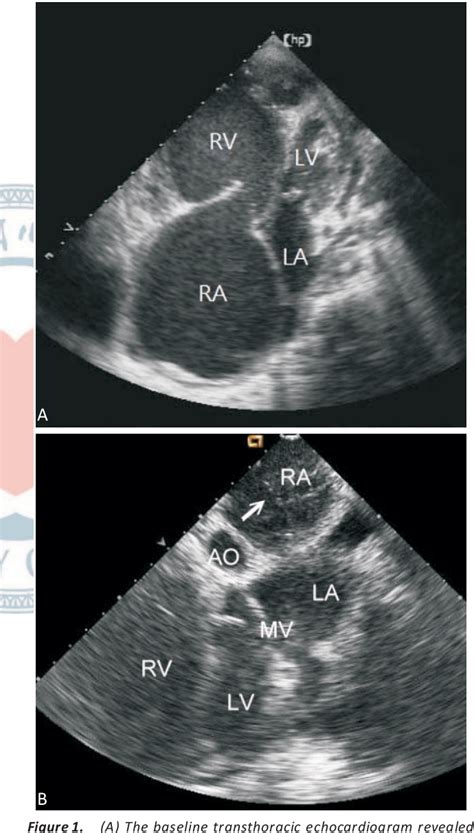 Figure 1 From Consecutive Sessions Of Rescue Balloon Atrial Septostomy