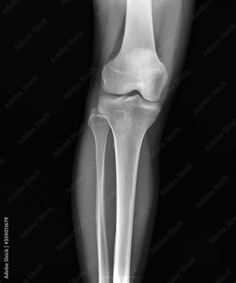 x-ray of the normal knee joint.medical diagnostics Stock Photo | Adobe ...