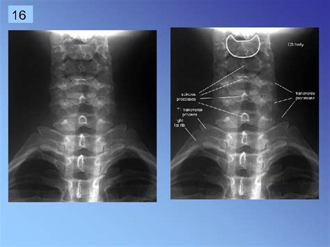 1 Cervical Spine Rtec 124 Week 6 Rev