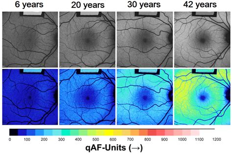 Jcm Free Full Text Fundus Autofluorescence And Rpe Lipofuscin In