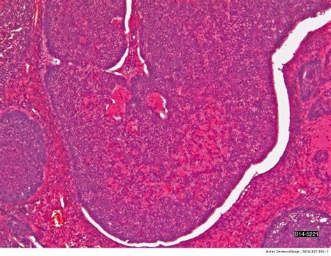 Carcinoma De Células Basales Con Fenotipo Cilindromatoso Actas Dermo