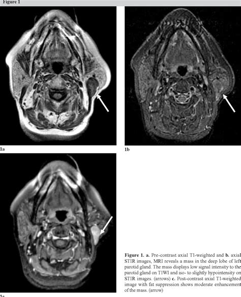 Parotid Gland Tumor Mri