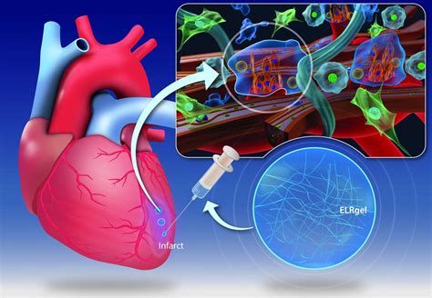 Hydrogel injection may change the way the heart muscle heals after a heart attack | Science Codex