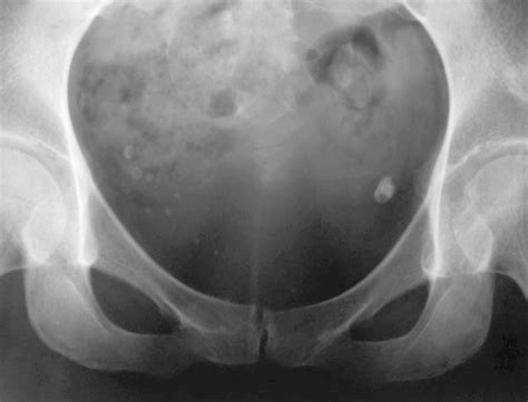 Soft Tissue Calcifications