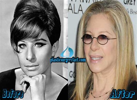 Barbra Streisand Plastic Surgery Before And After Pictures