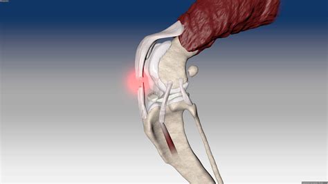 Patellar tendon reconstruction - Novetech Surgery