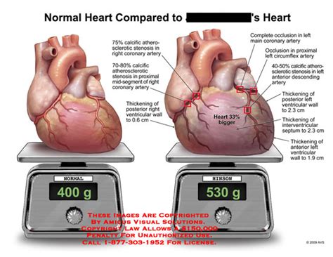 Amicus Illustration Of Amicusmedicalheartnormalcalcific