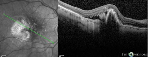 Atlas Entry Retinal Pigment Epithelial Rip