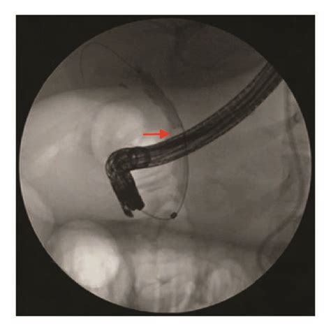 Nine Millimeter Cystic Duct Stone Visualized Using Peroral Cholangioscopy Download Scientific