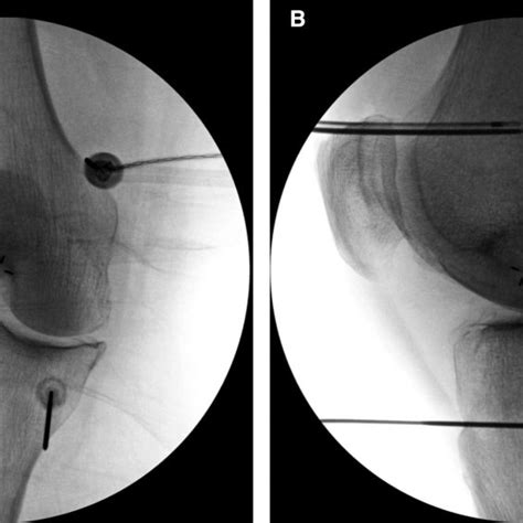 Pdf Cooled Radiofrequency Ablation Of The Genicular Nerves For Chronic Pain Due To Knee