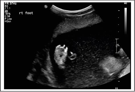 Figure 5 From Prenatal Sonographic Detection Of Multiple Congenital