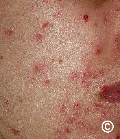 Dermatitis Artefacta Treatment