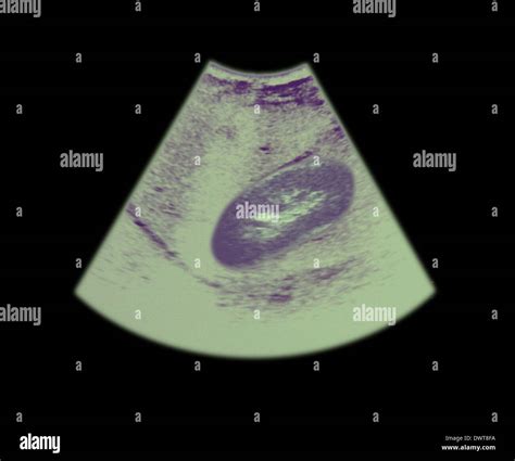 Kidney ultrasound scan Stock Photo - Alamy