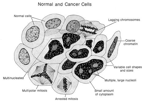 What are the Stages of Cancer? - Blue Ridge Radiation Oncology - BRRO