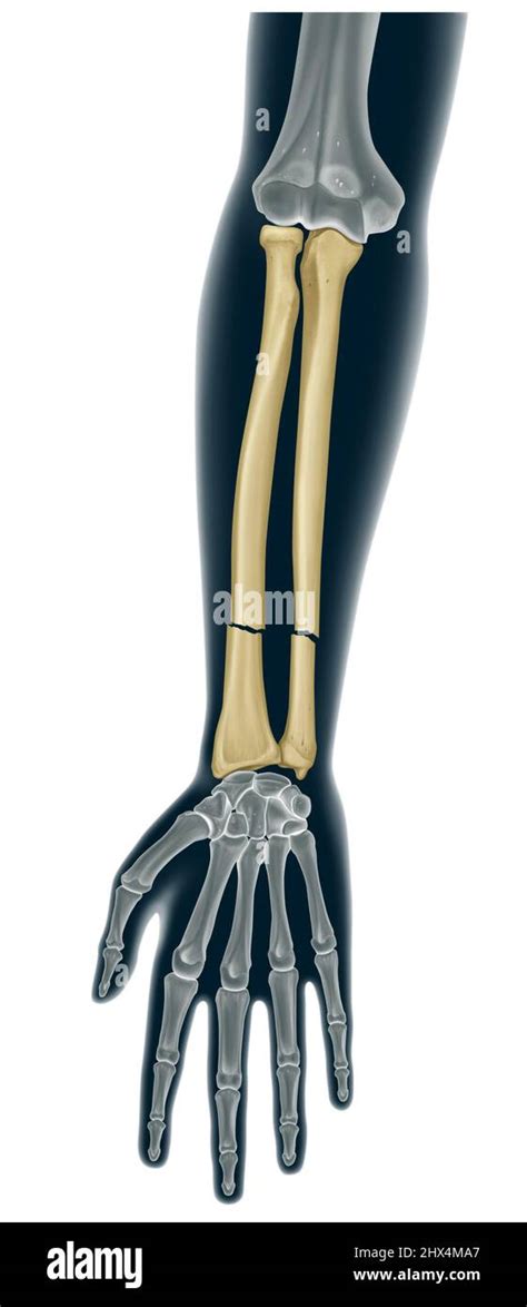 Bone Fracture Hi Res Stock Photography And Images Alamy