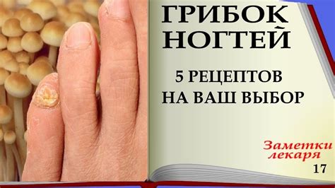 Как избавиться от грибка ногтей 5 проверенных народных рецептов от ...