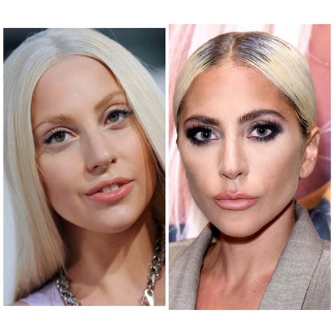 Lady Gaga Plastic Surgery Unveiling The Transformation