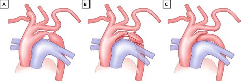 persistent fifth aortic arch | pacs