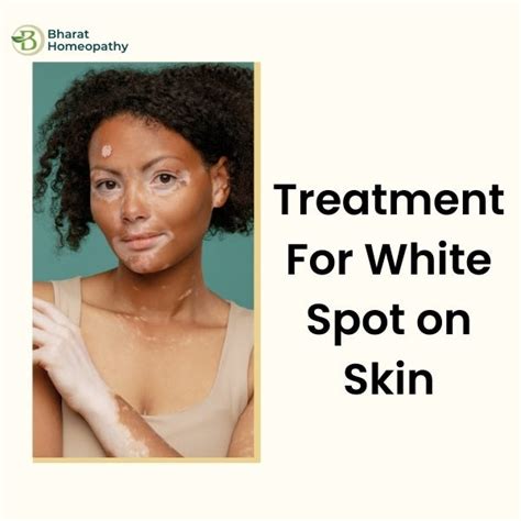 Vitiligo Treatment Naturally: Understanding Homeopathic Treatment for Vitiligo | by Ragini ...