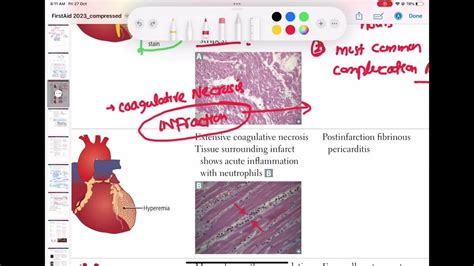 Post Myocardial Infraction Complication Cardiology 86 First Aid Usmle Step 1 In Urdu Hindi