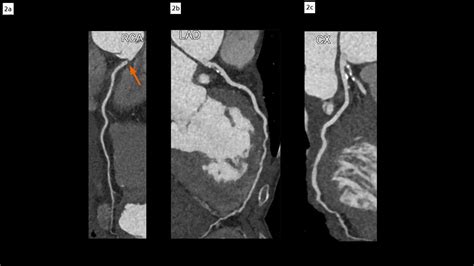 Spontaneous Localized Dissection Of The Right Coronary Sinus Of Valsalva