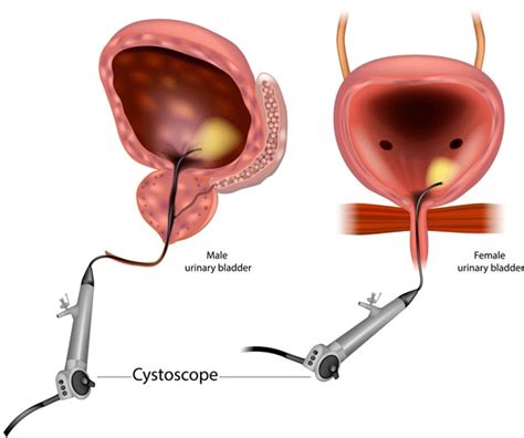 416 Cystoscopy Royalty-Free Photos and Stock Images | Shutterstock