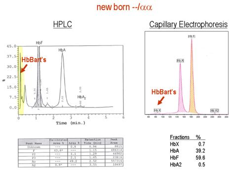 Hemoglobin Electrophoresis Sickle Cell Trait