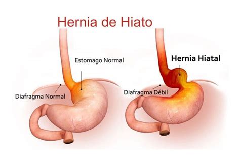 Reflujo GastroesofÁgico Y Hernia De Hiato Marta Seguí